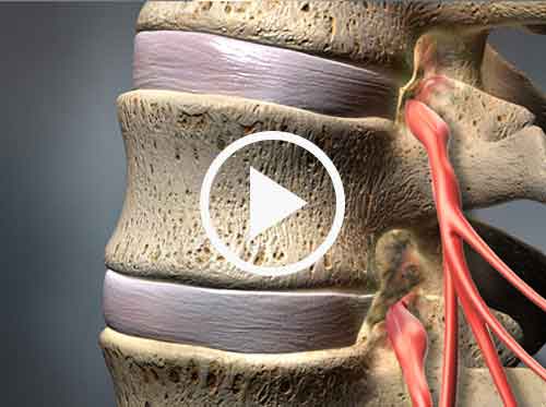 https://regenerativespineandjoint.com/wp-content/uploads/2019/12/stenosis_500i.jpg