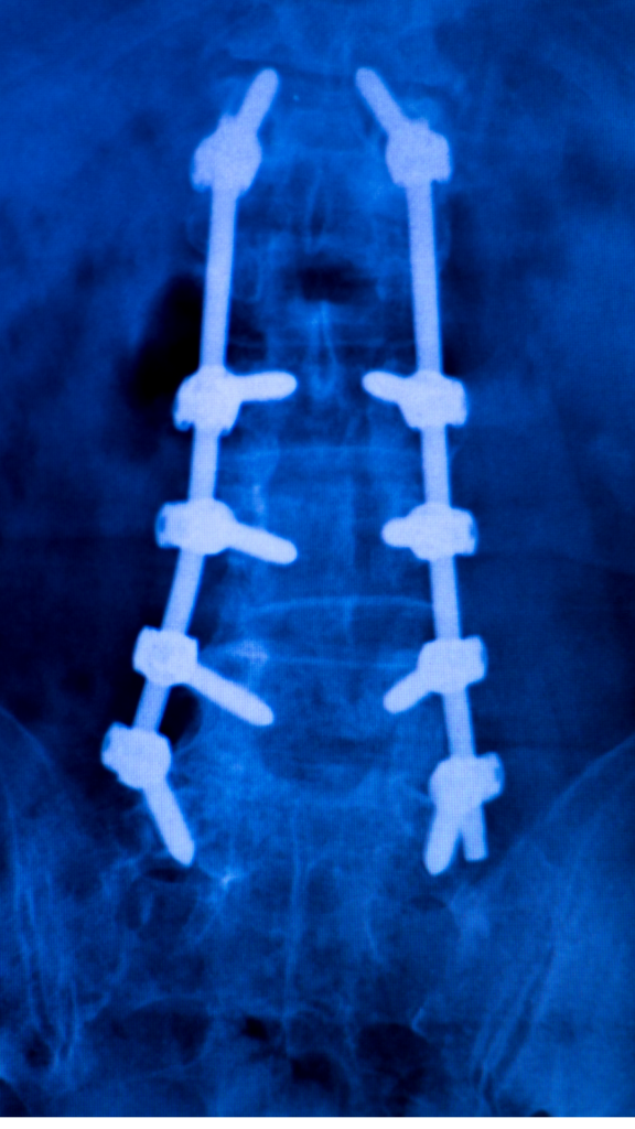 spinal fusion xray