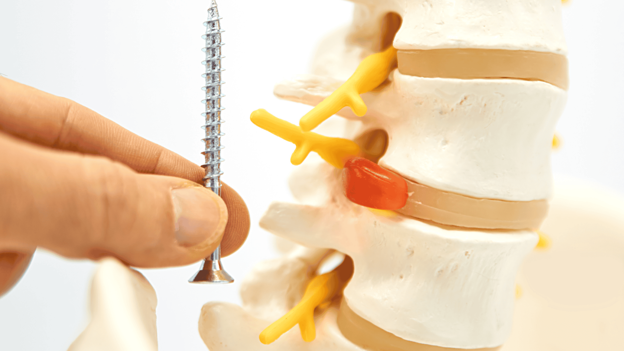 Adjacent Segment Degeneration After Spine Fusion Surgery Regenerative
