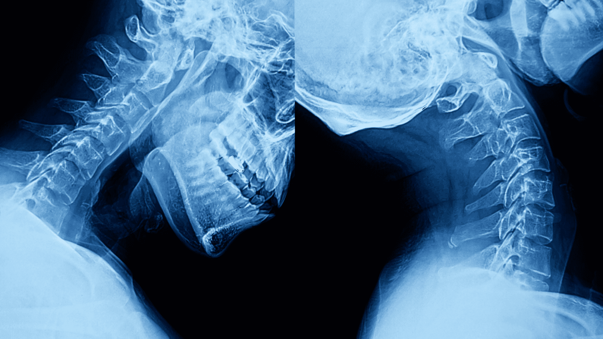 Cervical Radiofrequency Ablation (RFA) Neurotomy - Regenerative Spine ...