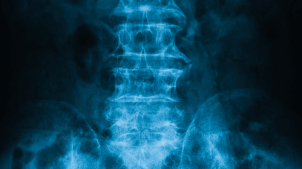 bone spurs and osteophytes