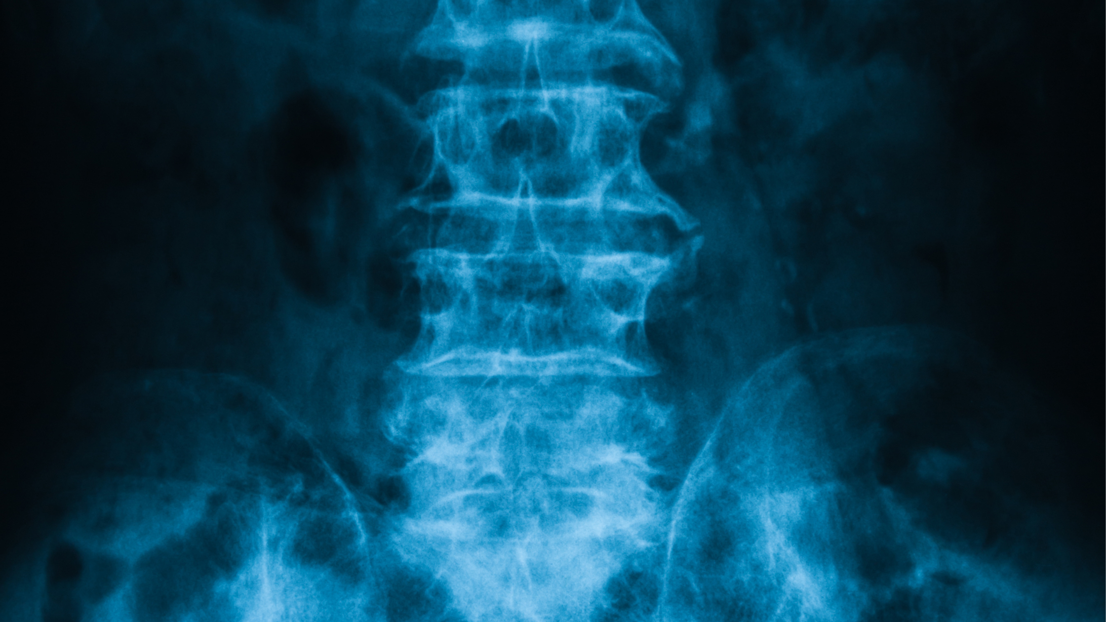 bone spurs and osteophytes